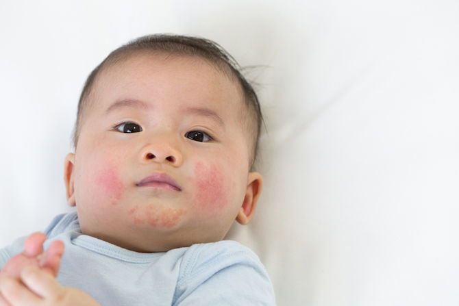 15 Tanda Bayi Alami Alahan Formula, Punca Susu Tidak Sesuai Dengan Bayi & Cara Mengatasi