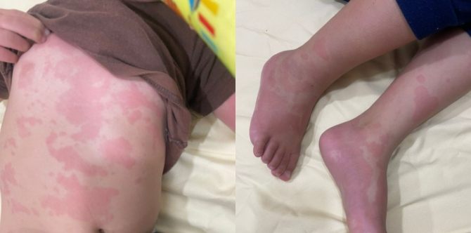 Tidak Semua Penyakit Urticaria @ Ludah Jin Berpunca Alergik Makanan, Ini Jawapan Doktor!