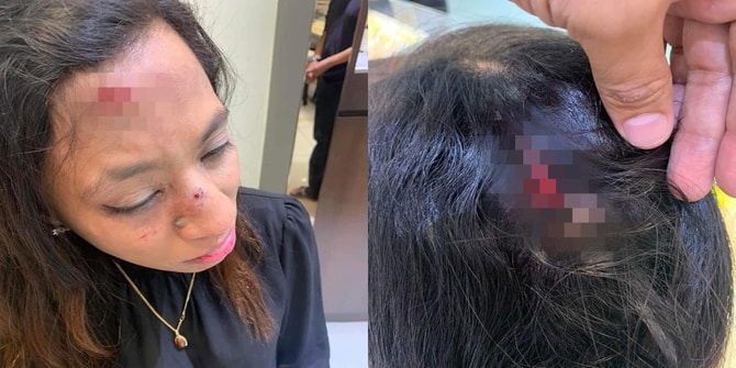 Ditendang & Mata Dikorek Peragut Kurang Siuman, Wanita Ini Trauma Keluar Bersendirian