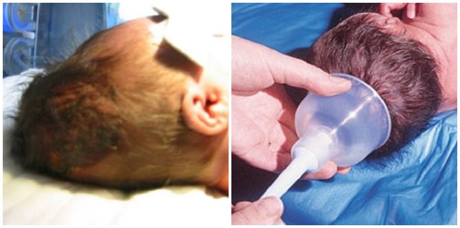 Bentuk Kepala Bayi Jadi Lonjong Selepas Bersalin Vakum, Ibu Jangan Memandai Tekan