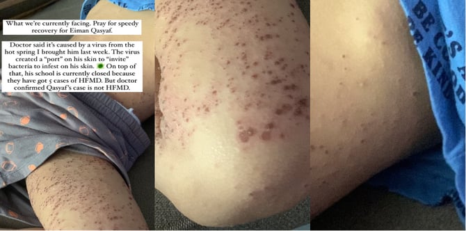 Bawa Anak Ekzema Mandi Kolam Air Panas, Ibu Kesal Seluruh Badan Melepuh & Naik Bintik-Bintik