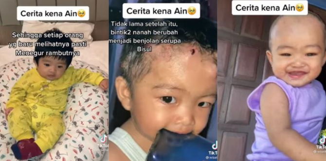 Kisah Benar: Bayi Selalu Dipuji Orang Sekeliling, Kepala Jadi Bernanah Disebabkan Penyakit Ain