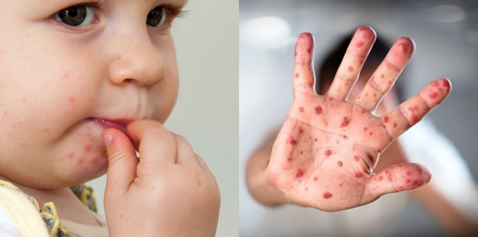 #TAPTanyaDoktor: Apa Yang Anda Perlu Tahu Tentang Jangkitan Penyakit HFMD Pada Anak