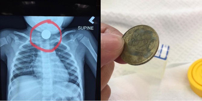 Anak Dalam Fasa Mengutip, Tertelan Duit Syiling Hingga Sukar Bernafas & Muntah Non Stop