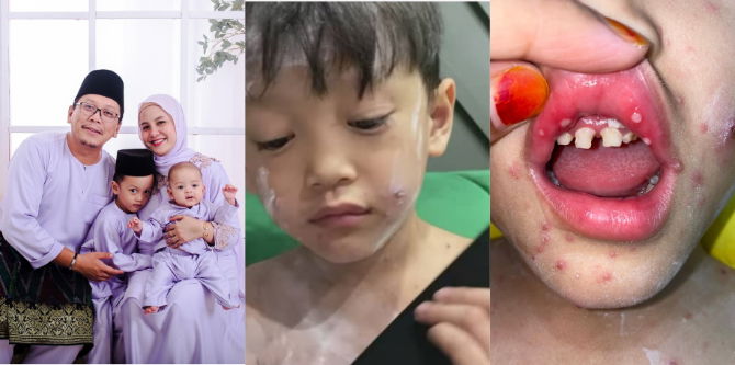 Badan Gatal-Gatal & Mulut Penuh Ulser, Anak Sharol Shiro Alami Demam Chicken Pox