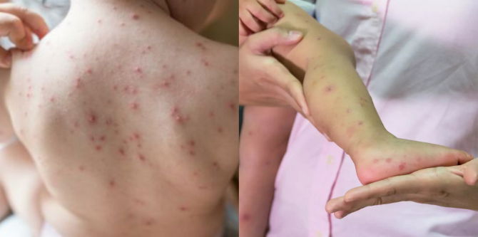 Kanak-Kanak Bawah 5 Tahun Ramai Dijangkiti, Waspada Virus Baharu Selesema Tomato Kini Merebak Di India