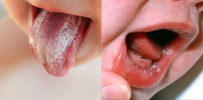 Kulat Susu: Mulut & Lidah Baby Ada Tompokan Putih? Ia Mungkin Kulat Susu Punca Bayi Sukar Menyusu