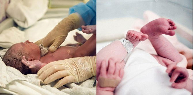 Hypospadias/ Kecacatan Kelahiran Pada Bayi Lelaki, Ibu Ayah Peka 4 Tanda Gangguan Ini