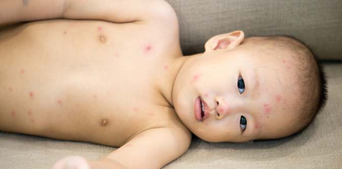 Apa Bintik-Bintik Di Badan Itu? Ini Simptom Cacar Air Yang Sering Disalah Baca Oleh Ibu Bapa