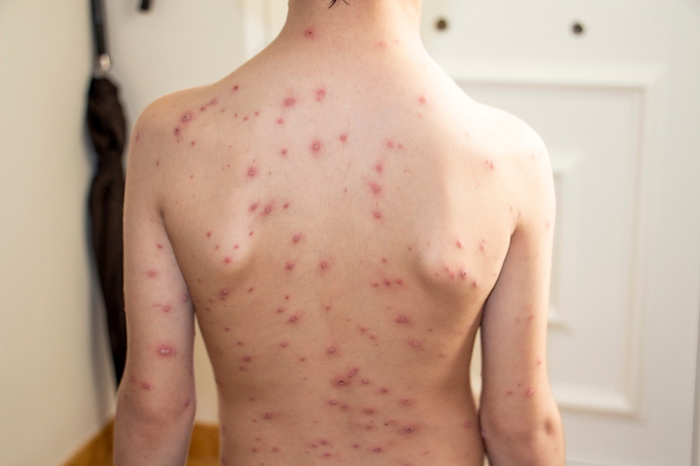 Penyakit tangan kaki dan mulut dan cacar air merebak melalui kontak rapat atau sentuhan dengan kanak-kanak yang dijangkiti.