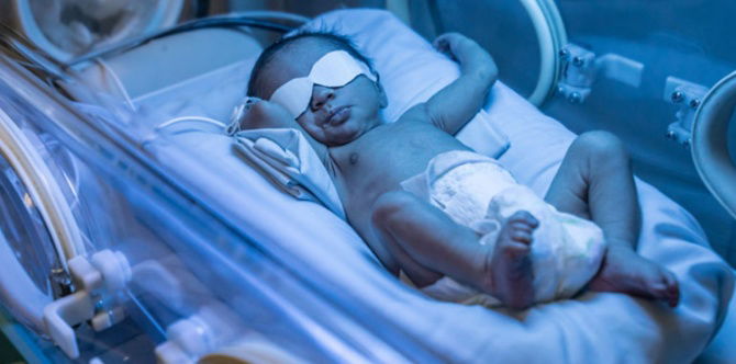 Bayi Demam Kuning Lama/ Prolonged Jaundice, Ini Punca & Petua Berkesan Untuk Ibu Cuba