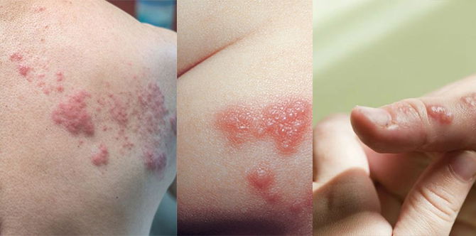 Cara Rawat Kayap Ular Secepat Mungkin, Elak Komplikasi Lebih Teruk