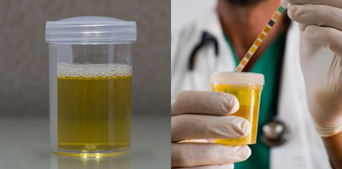 Kencing Berbuih? Ini Panduan Untuk Anda, Punca Dan Petua Hilangkan