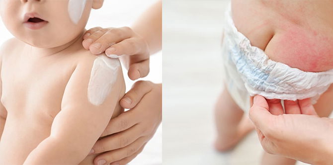 Anak Tak Selesa Bila Kena Ruam Lampin, Ibu Cuba 9 Cara Paling Mudah Ini Untuk Lindungi Kulit Si Manja!