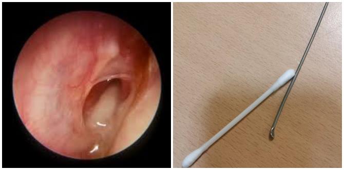 Anda Suka Korek Telinga? Hati -Hati Boleh Mengakibatkan Gegendang Telinga Pecah!