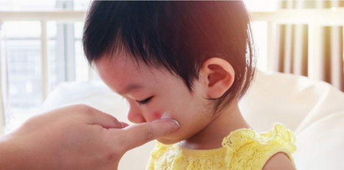 Gigitan Serangga Pada Anak (Insects Bites): Jenis Gigitan Serangga, Tanda & Cara Menghilangkan Bekas Gigitan Serangga Anak