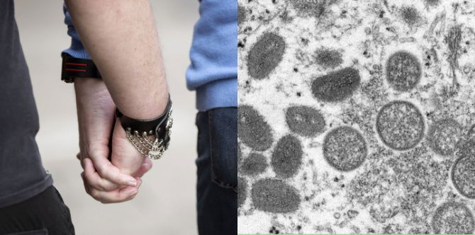 Monkeypox Bukan Penyakit Gay, Sesiapa Sahaja Berisiko Dijangkiti Penyakit Ini! Jangan Ambil Mudah