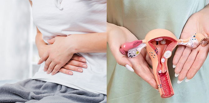Endometriosis vs Adenomiosis: Kenali Perbezaan, Punca, Gejala Dan Cara Mengatasinya