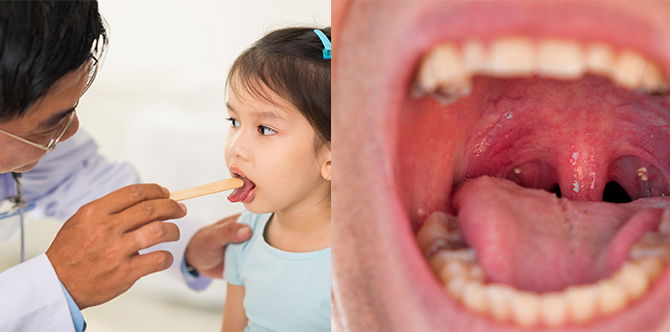 10 Pantang Larang Semasa Sakit Tonsil & Selepas Buang, Jangan Buat Ini Kalau Nak Cepat Sembuh!