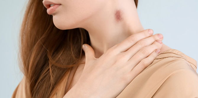 Cara Buat Love Bite Yang Betul Agar Pasangan Bertambah Ghairah & Tip Pudarkannya