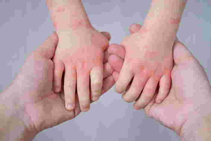 Close Up Mother Holding Kids Hands With Allergic Rash,